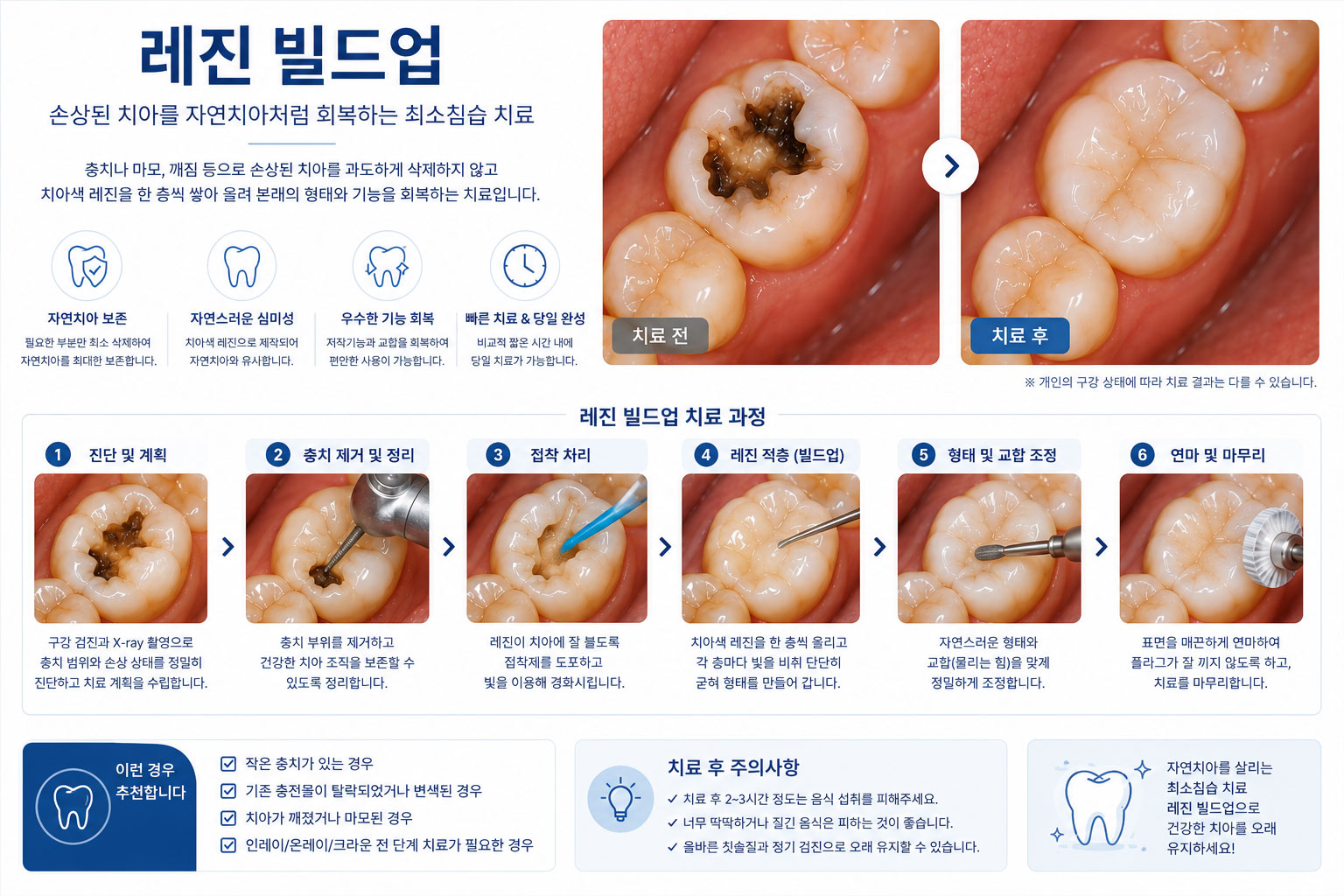 진접 레진 빌드업 연세미소미함치과 — 앞니 광중합 레진 형태 개선 과정
