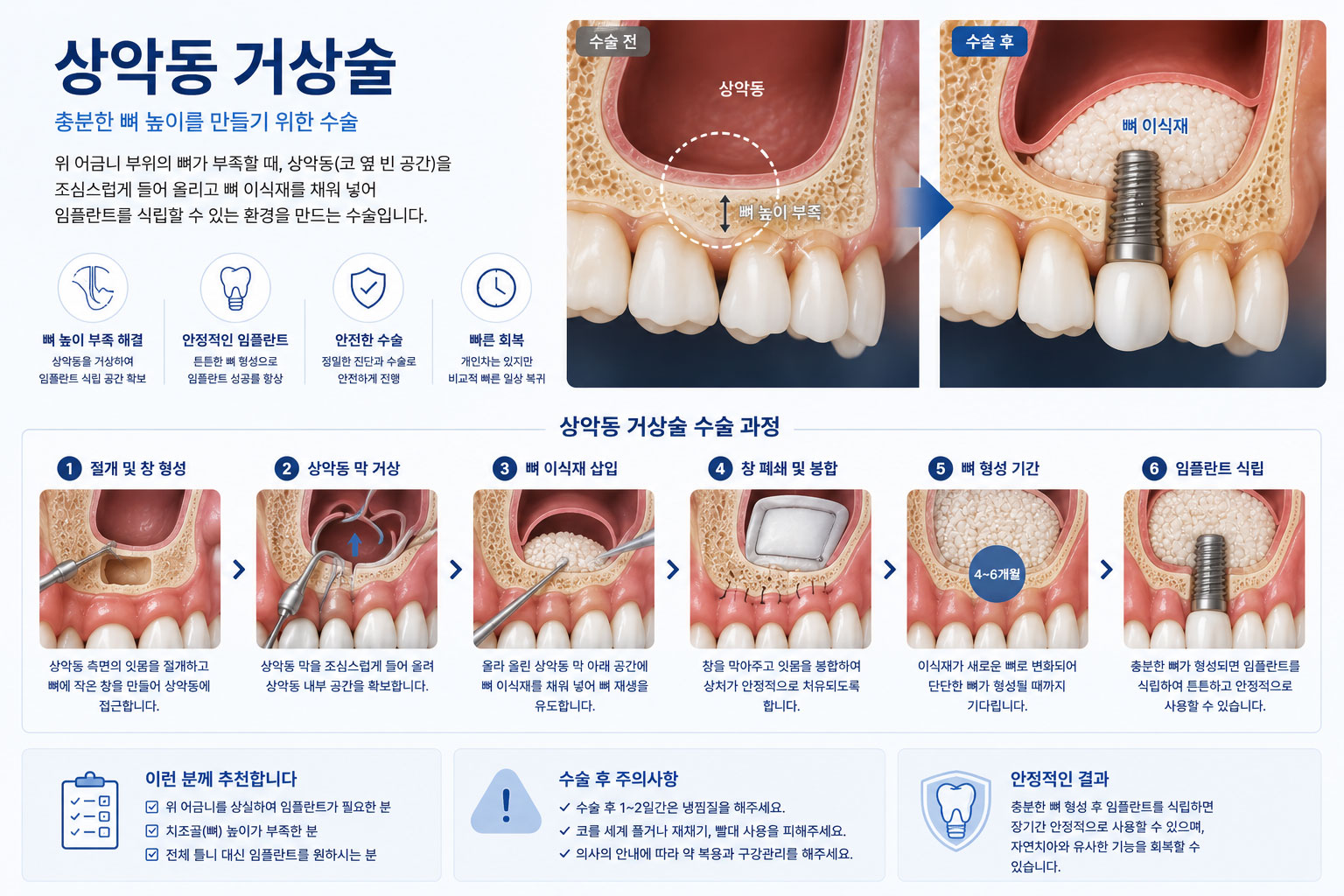 진접 상악동 거상술 연세미소미함치과 — 위턱 상악동 바닥 거상 후 골이식 과정