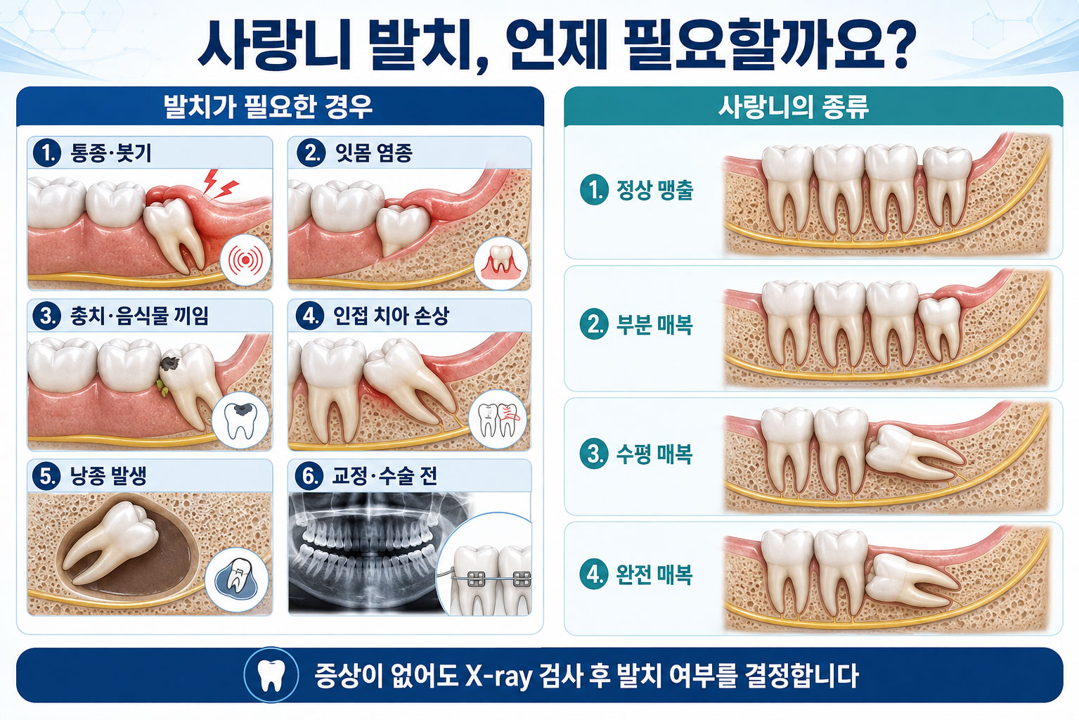오남 사랑니발치 연세미소미함치과 — 매복 사랑니 3D CT 정밀 발치