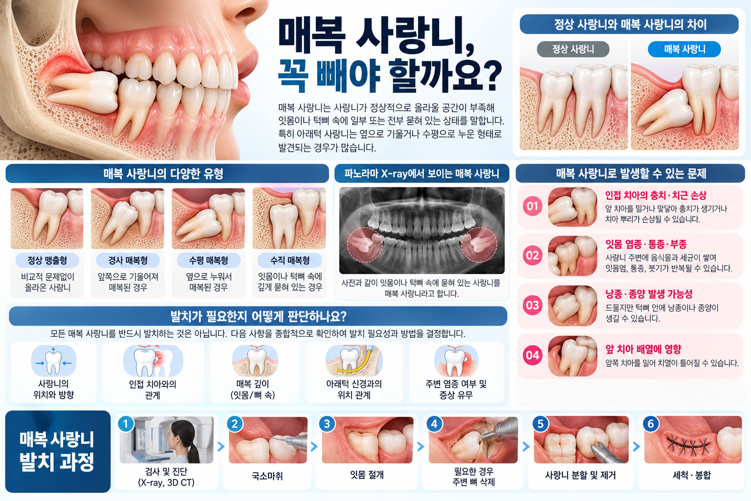 매복 사랑니 신경 위치 — 하치조신경과 사랑니 뿌리의 근접 관계