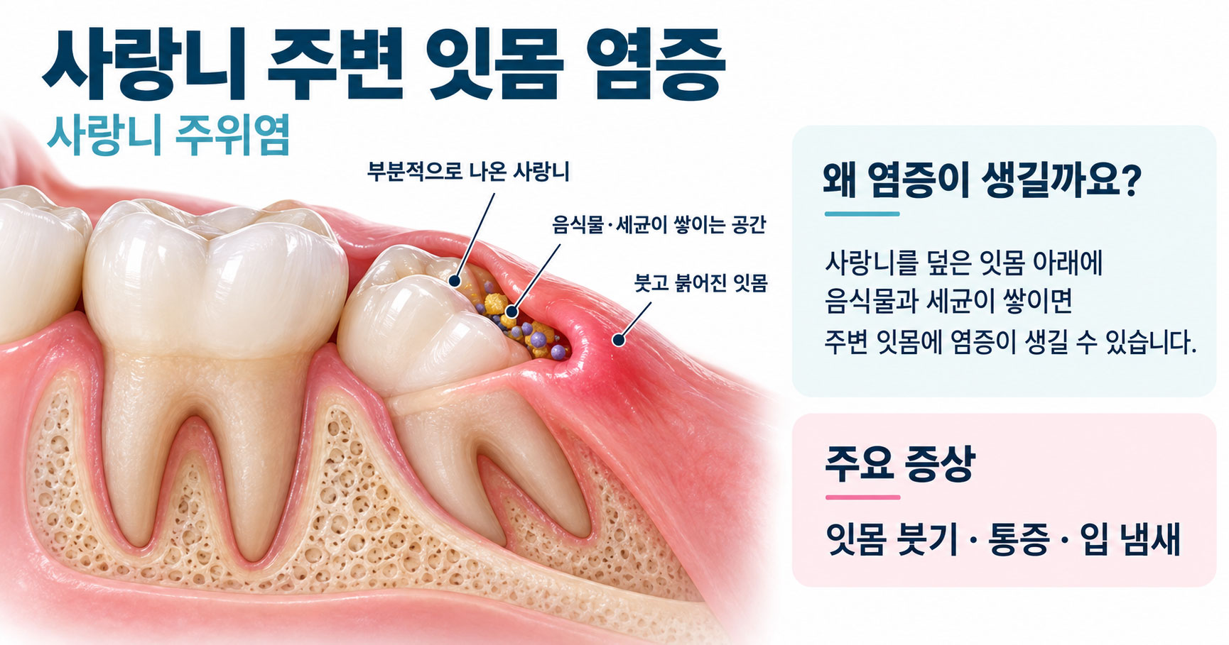 사랑니 잇몸 염증 — 잇몸 덮개 아래 좁은 틈에 세균이 쌓여 염증이 반복되는 구조